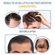 5% Minoxidil Foam for Hair Growth & Regrowth – Slows Hair Loss, Promotes Thicker, Longer Hair – 2 Month Supply